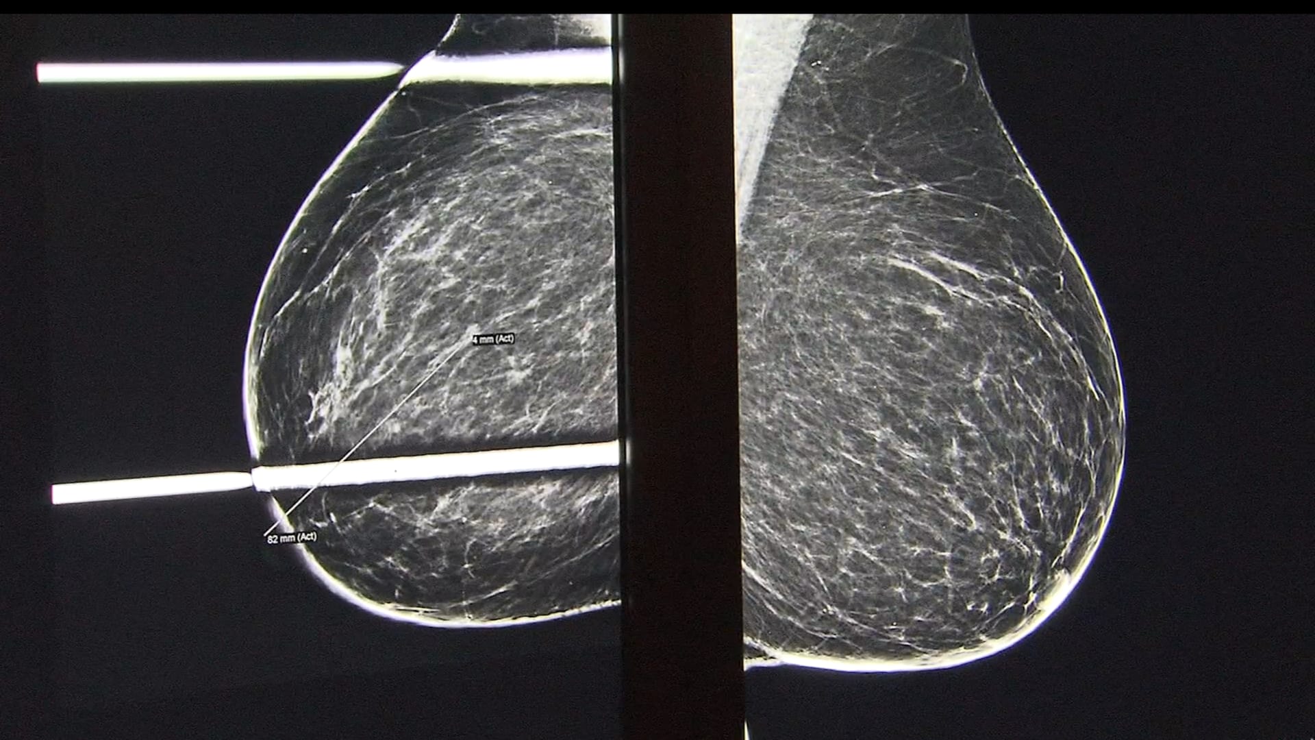 نوع خفيّ من سرطان الثدي يفلت من صور الماموغرام ويصيب حالة من كل عشر نساء