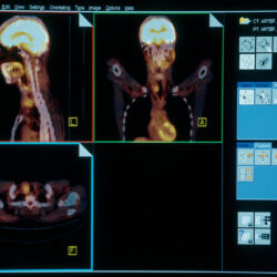 حقن تخفيض الوزن قد تؤثر على فحوصات السرطان وتسبب قلقا لا داعي له