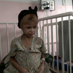 دراسة: أكثر من 54 ألف طفل في غزة يعانون من سوء تغذية حاد