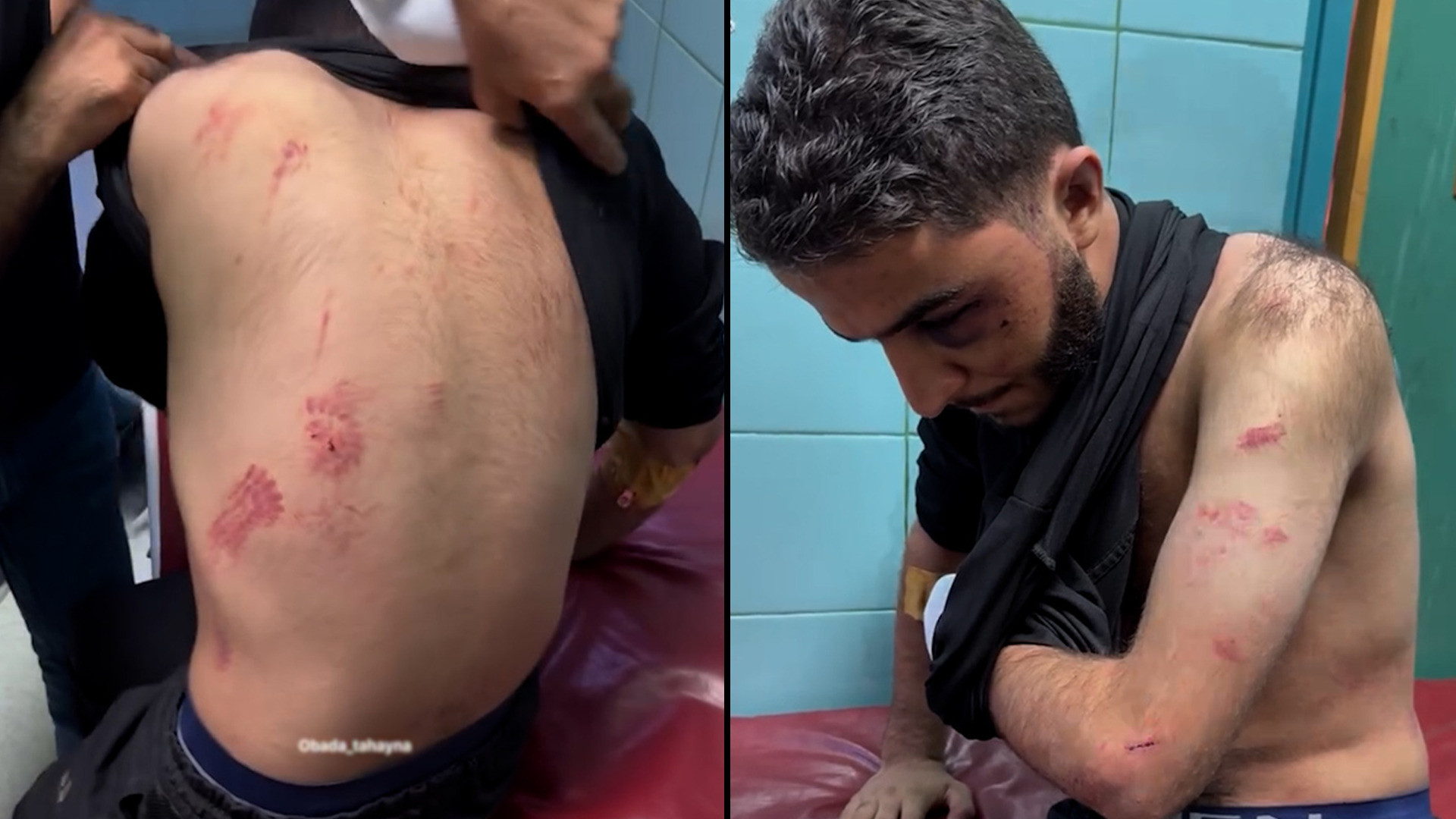 شاهد.. آثار تعذيب الاحتلال شبابا من جنين
