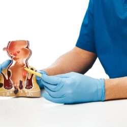 نزيف الشرج يشير لاحتمالية سرطان القولون