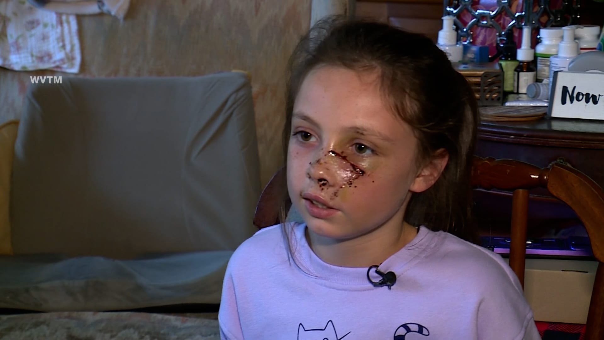 تركها ملطخة بالدماء.. كلب ينهش وجه طفلة ويعود ليهاجمها ثانية بجسدها