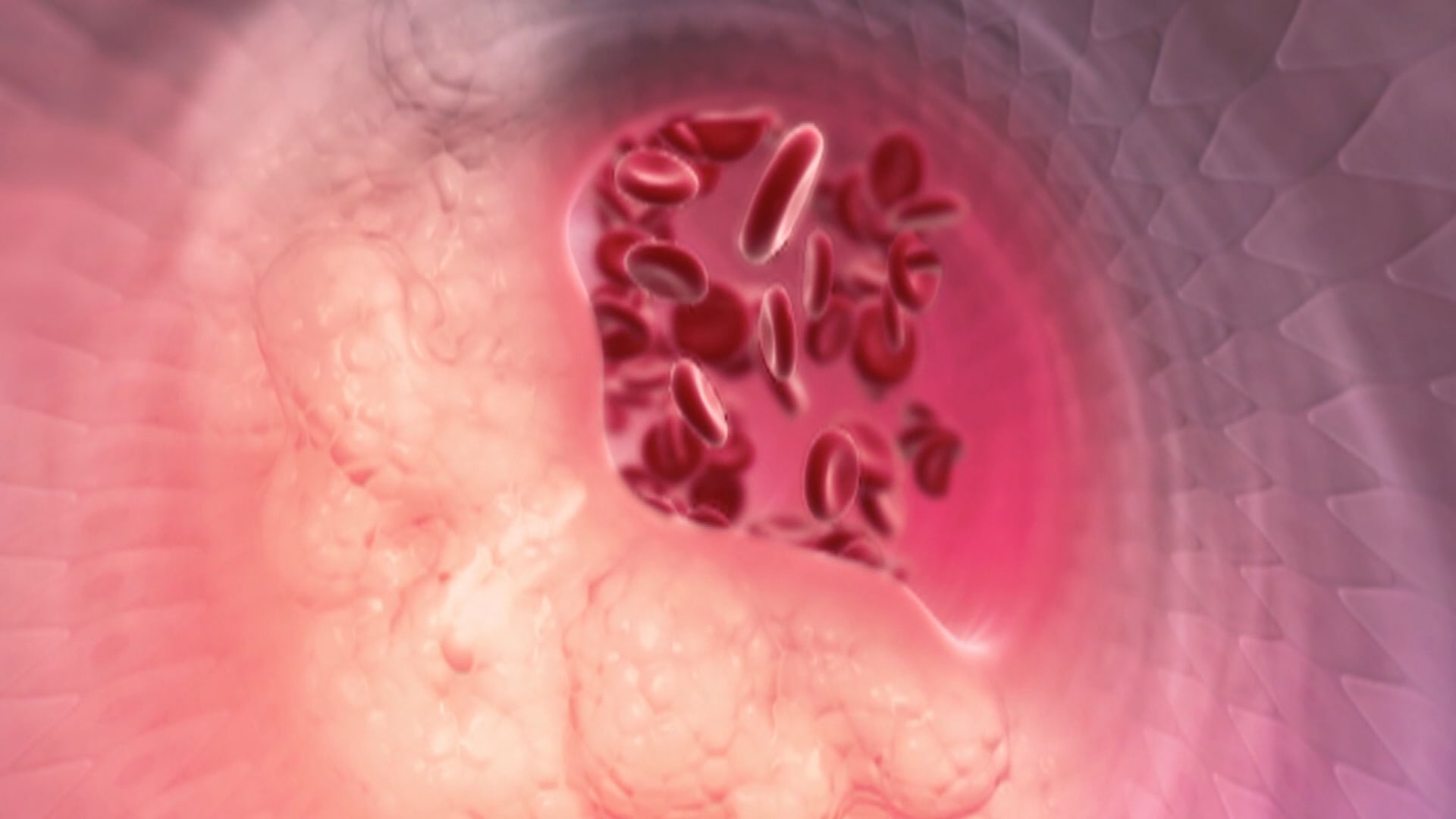 دراسة: حبّة تجريبية واعدة تخفّض الكوليسترول الضار بنسبة 60%