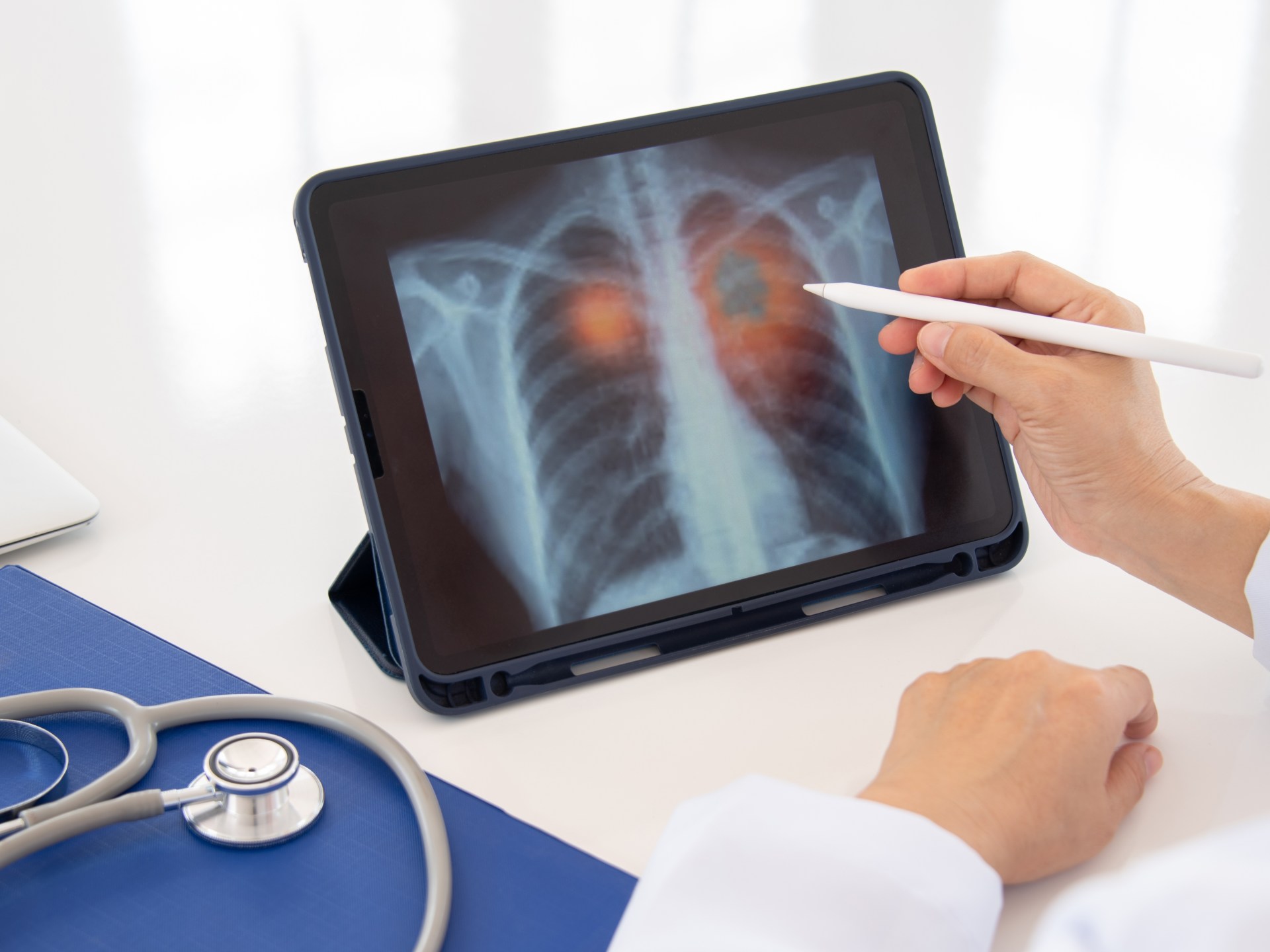 2Lung cancer 1764654728