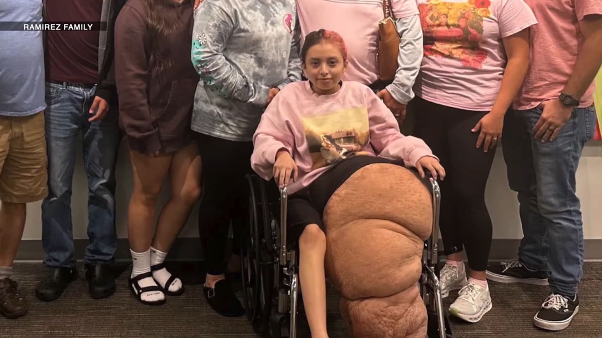 تجاوز وزنها 70 كيلوغرامًا.. مراهقة تعاني من حالة نادرة انتهت ببتر ساقها