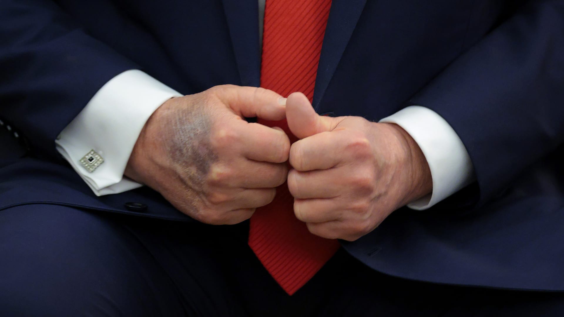 صحة ترامب.. لماذا تثير كدمات يد الرئيس الأمريكي الأكبر سناً التساؤلات؟