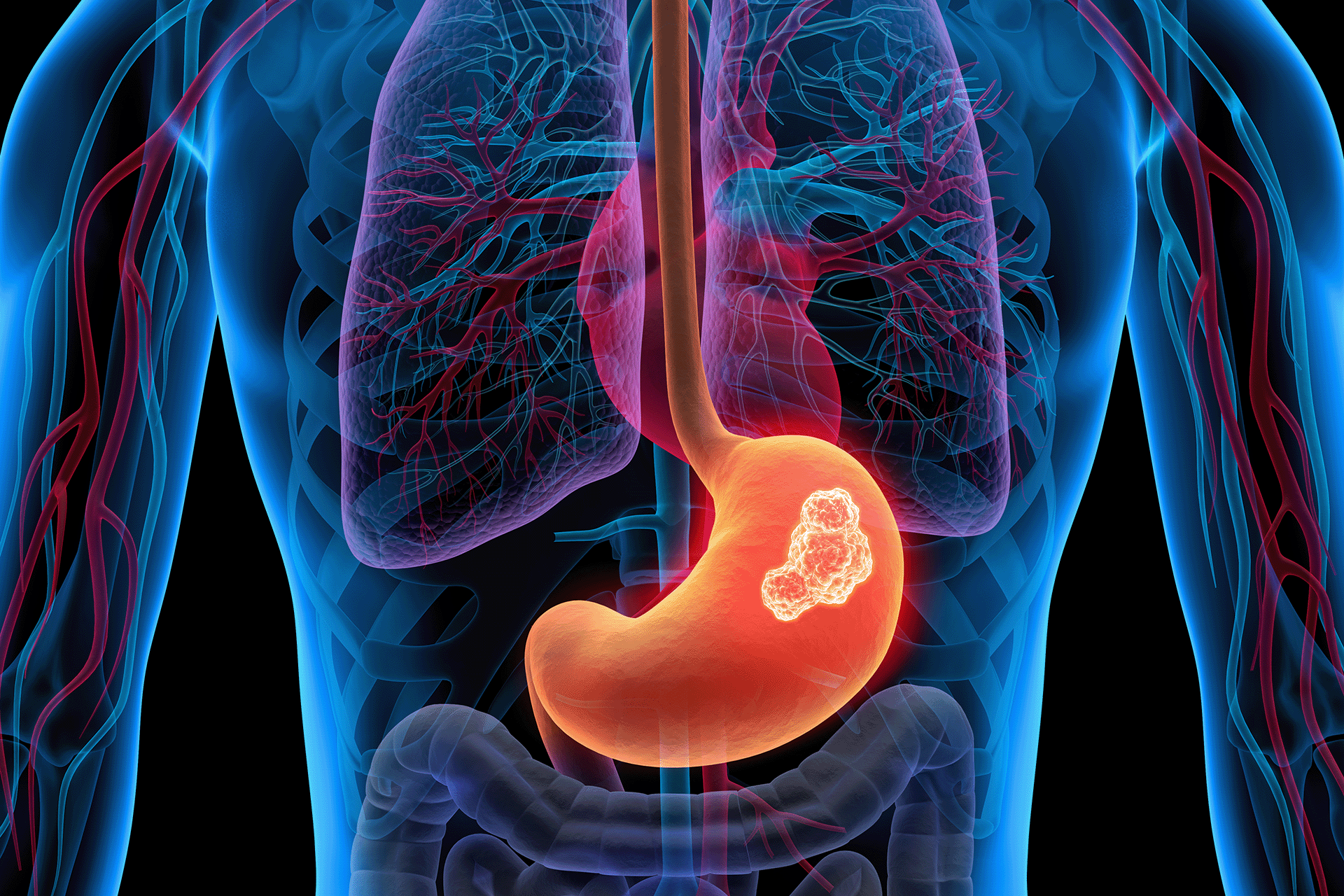 هل لأدوية الحموضة علاقة بسرطان المعدة؟