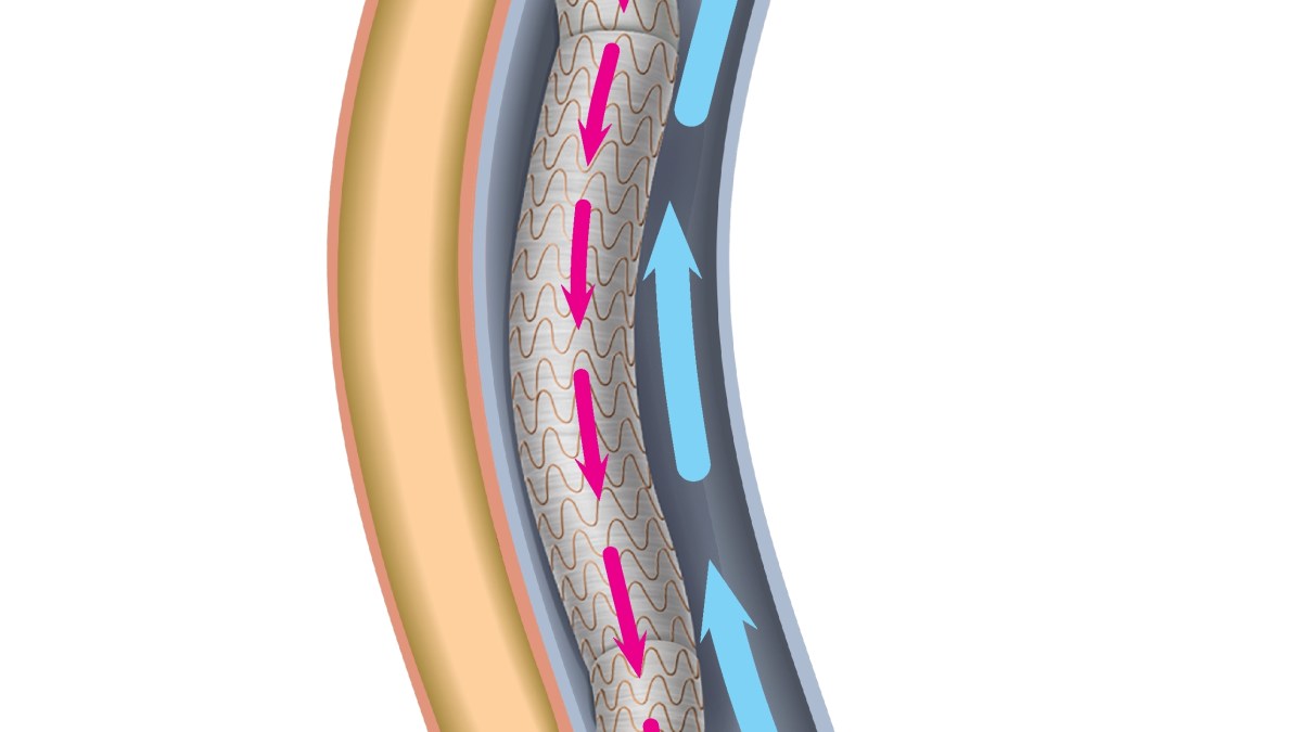 أول جراحة لتحويل مسار الشريان التاجي دون فتح الصدر