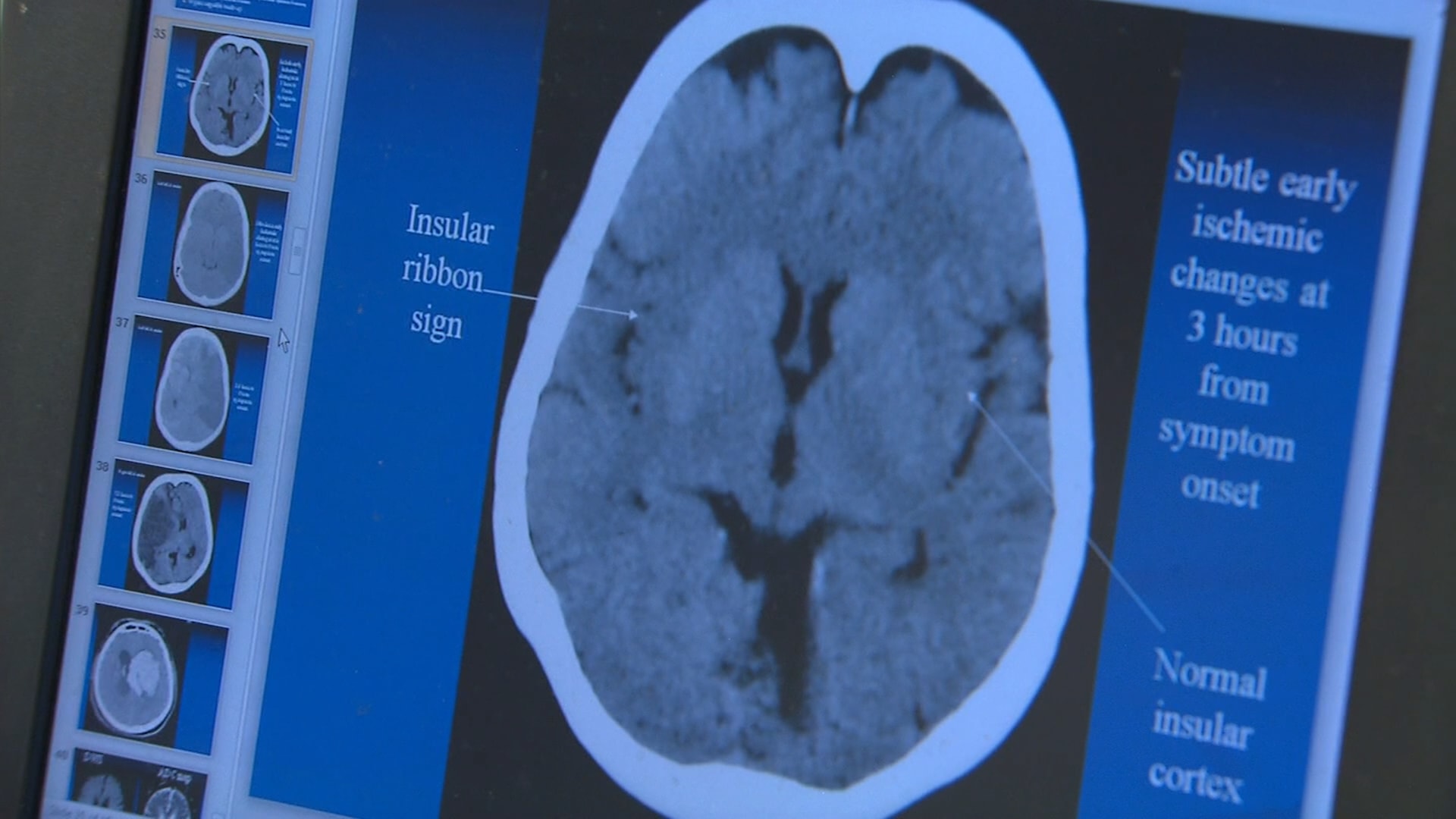 التعب والهبّات الساخنة وتغيّرات المزاج.. كيف نميّز بين أعراض سنّ اليأس والتصلّب المتعدّد؟