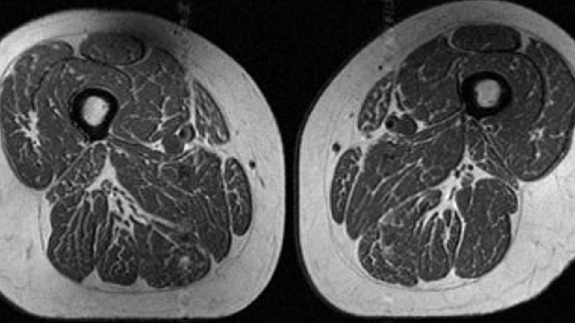 هذه ليس شريحة لحم بل فخذ امرأة.. هكذا تدمر الأطعمة فائقة المعالجة جودة عضلاتك
