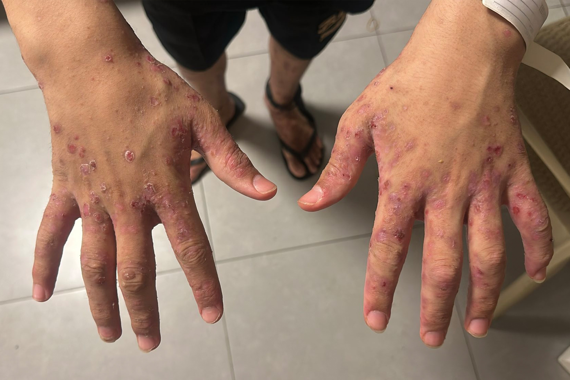 داء الجرب يجتاح سجون الاحتلال واتهامات بتعذيب ممنهج للأسرى